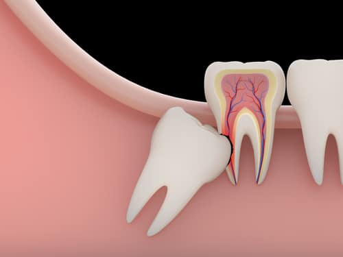 Example of an impacted wisdom tooth that needs to be removed by our dentists in Burleson, TX