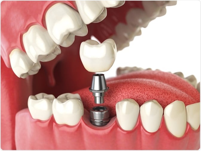 dental implants in burleson tx