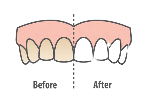 illustration of before and after teeth whitening