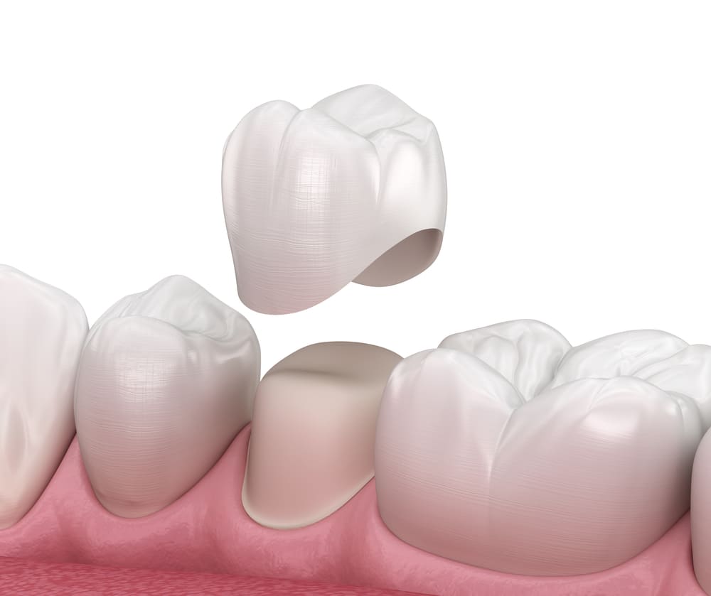porcelain crowns in burleson tx