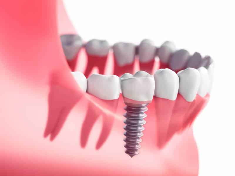 Example of a dental implant like our Burleson dentists would place